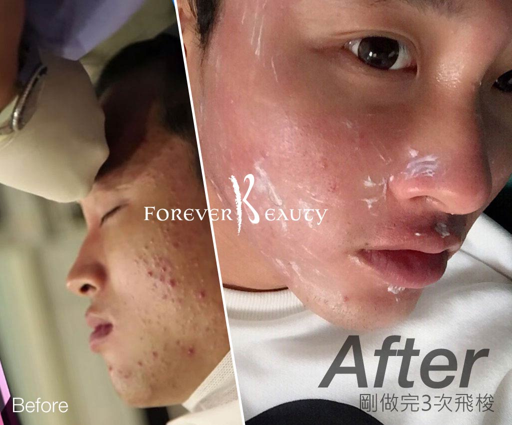 實在不可思議_恆麗美型_全套微整形_飛梭換膚