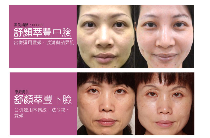舒顏萃案例_童顏針案例_童顏針推薦_台灣童顏針_台灣舒顏萃名醫_恆麗美型_蔡家碩