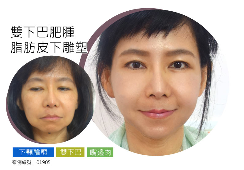經典案例_皮下燃脂