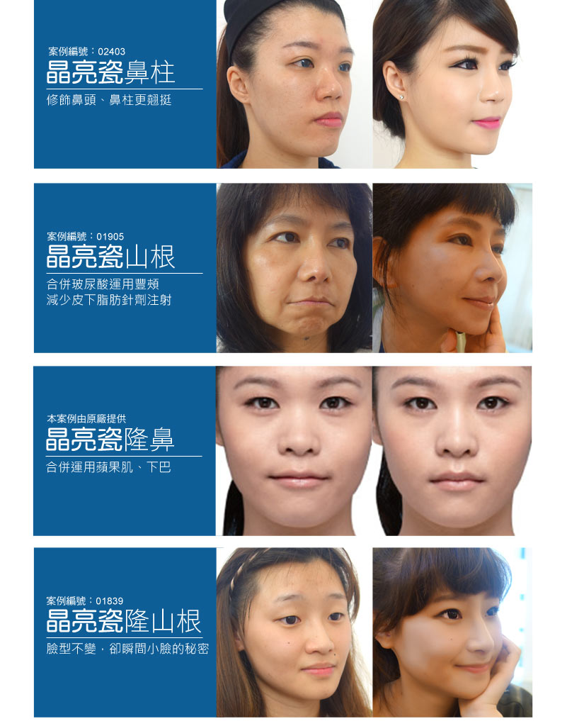 Radiesse_微晶磁案例_恆麗美型_蔡家碩_微整形台灣_晶亮瓷價格