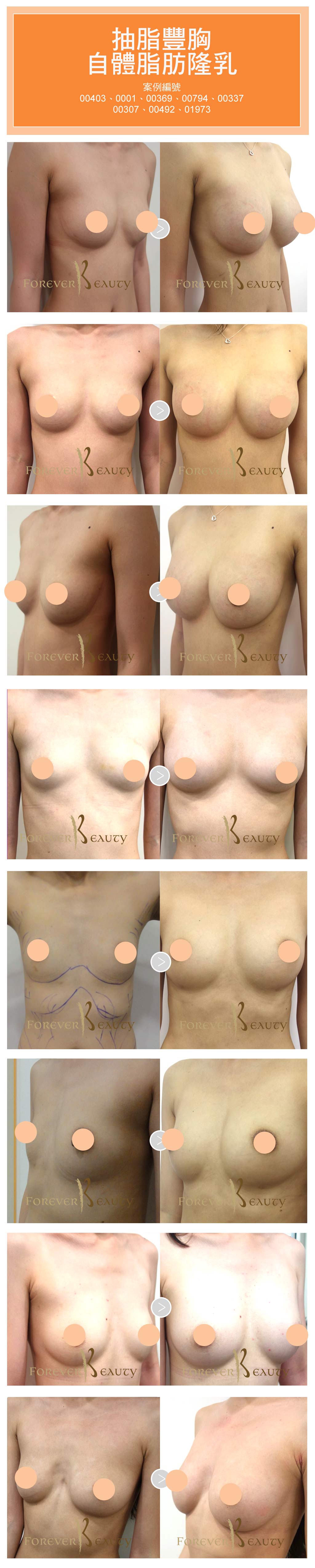 fat_breast_180504
