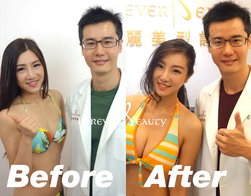 恆麗美型_蔡家碩_藝人抽脂隆乳案例_術前術後3