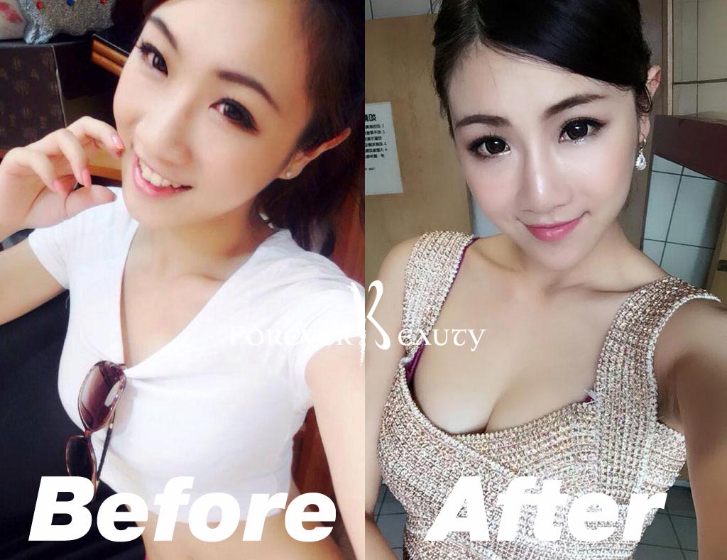 恆麗美型_蔡家碩_藝人抽脂隆乳案例_術前術後5