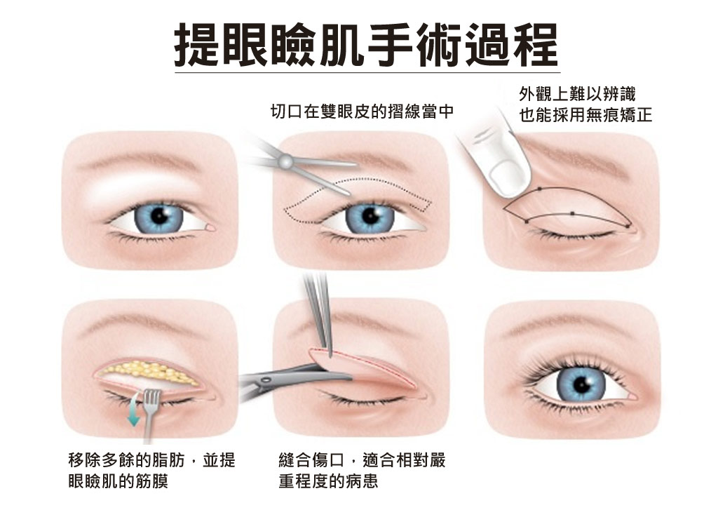 眼瞼肌拉提_恆麗美型_賴衍翰_蔡家碩_眼瞼肌手術_眼神放大手術_眼神手術_雙眼皮手術_眼瞼肌手術推薦_眼瞼肌手術療程_03