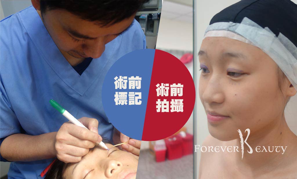 術前準備＿割雙眼皮手術＿賴衍翰＿恆麗美型
