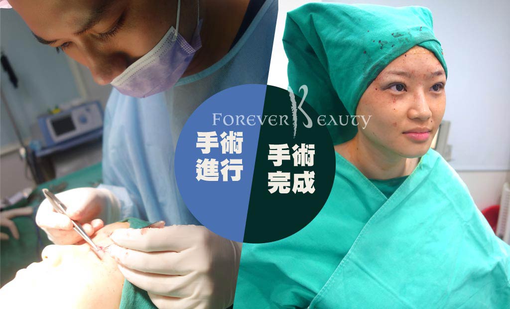 手術進行＿賴衍害醫師_恆麗美型_雙眼皮