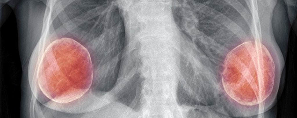 乳房植物入致癌風險_果凍矽膠致癌_果凍矽膠癌症_隆乳癌症_隆乳失敗_隆乳後遺症_恆麗美型_蔡家碩.jpg