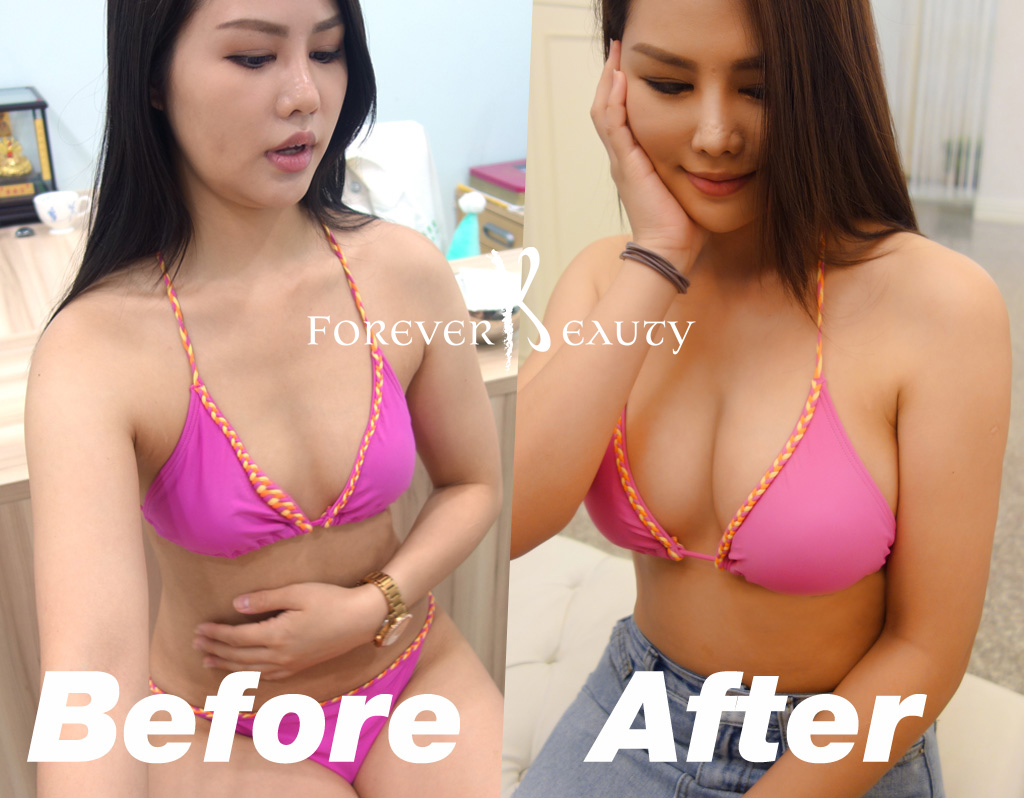 術後_全身對比圖4_自體脂肪隆乳案例_自體脂肪豐胸_台灣隆乳推薦_香港隆乳_台灣隆乳價格_隆乳風險_果凍矽膠隆乳_恆麗美型_蔡家碩_TOP